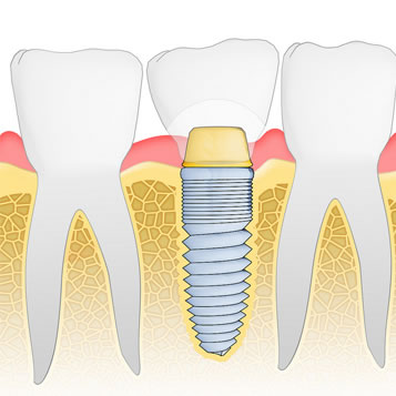 implant services