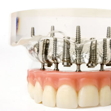 implant supported dentures